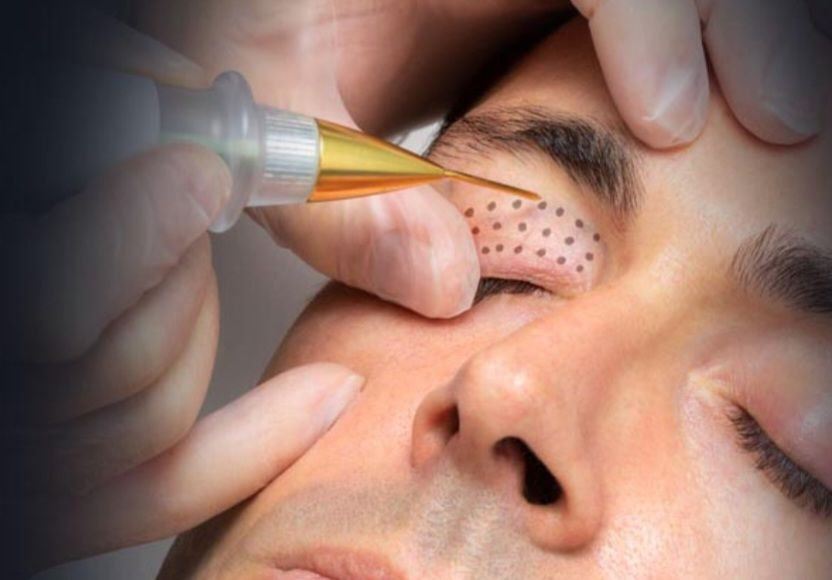 Le-soin-Plasma
